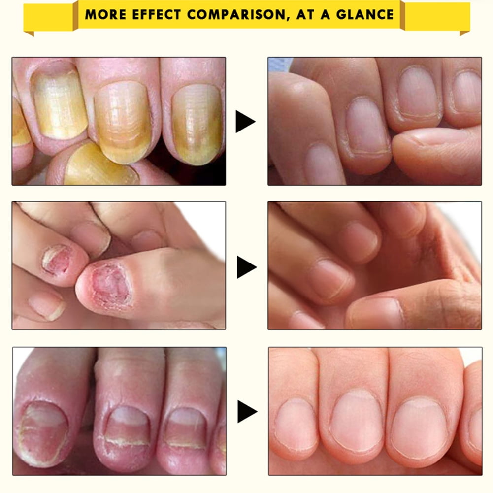 Anti Fungal Nail Treatment Pen Finger Toe Care Nail Fungus Fungi Liquid  Repair | eBay